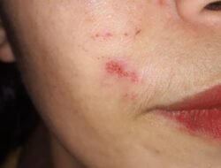 LP.K.P.K Soroti Vonis Percobaan dalam Kasus Penganiayaan: Dinilai Tidak Berkeadilan bagi Korban